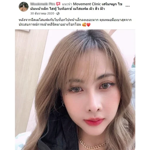 review_botox_05